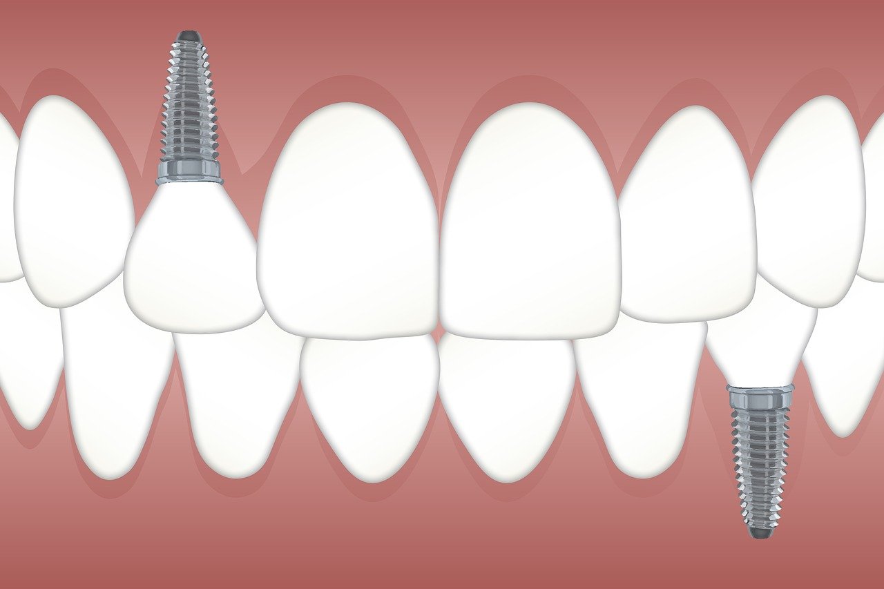 Jak wygląda wszczepienie implantu zębowego?